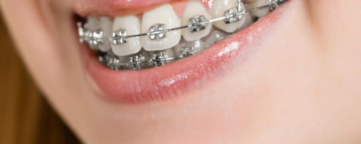 Ortodontia e Ortopedia Funcional dos Maxilares (DUPLA CERTIFICAÇÃO) - ORTO922